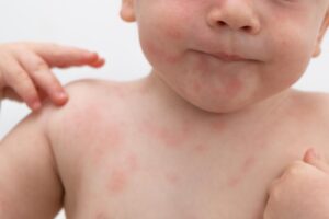 Las alergias en intolerancias en los bebés